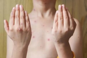 Pęcherzyca zwykła: symptomy i leczenie