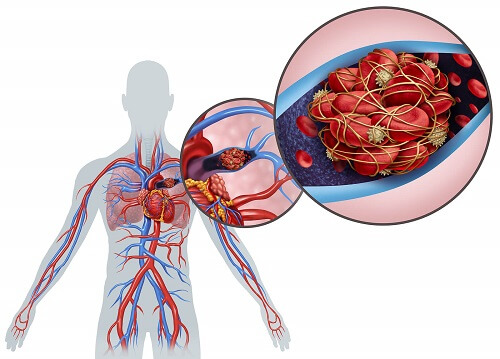 Zator tętnicy płucnej - schemat