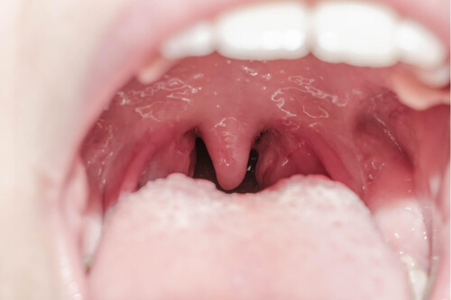 Zapalenie jamy ustnej