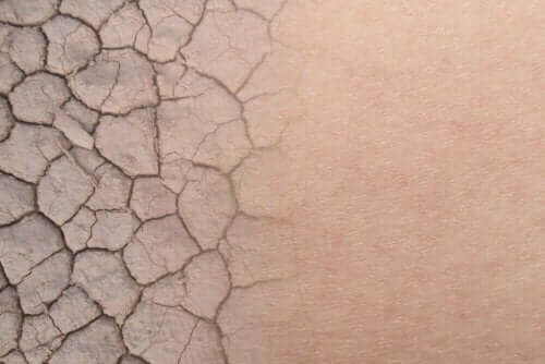 Zbliżenie suchej skóry