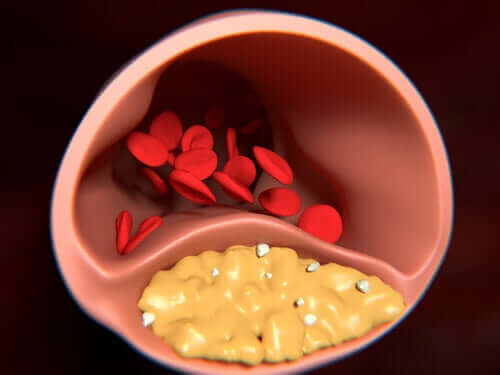 Arterioskleroza