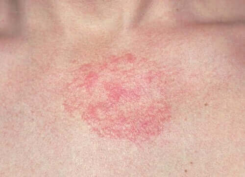 Dermatoza