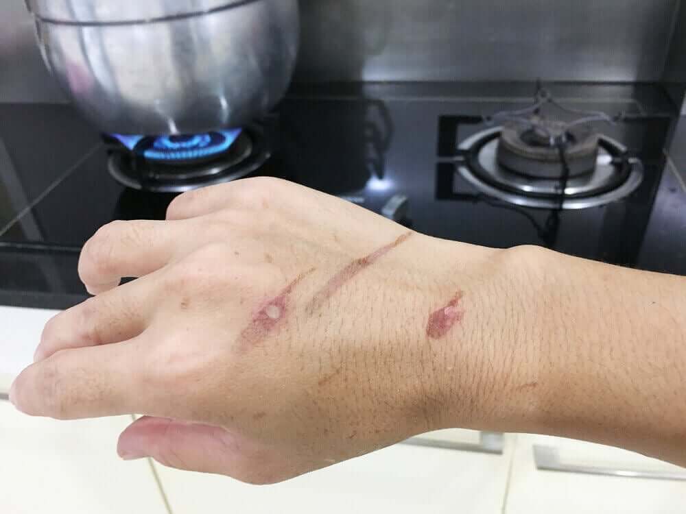 Poparzenia wrzątkiem i parą zdarzają się zwykle podczas pracy w kuchni.