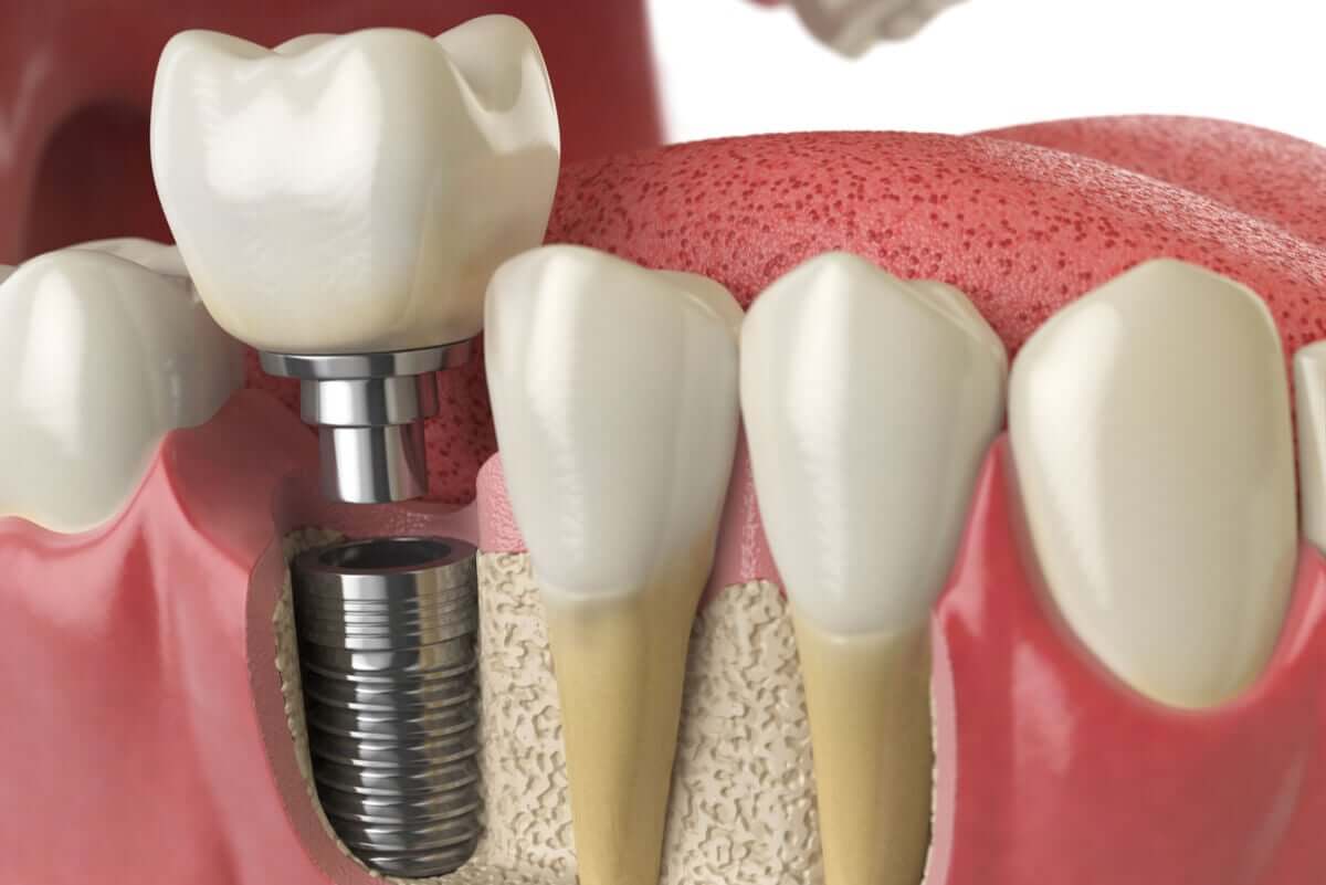 Implant zębowy to materiał biosyntetyczny wszczepiony w kość.
