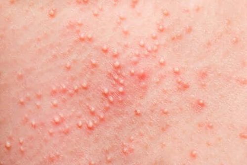 Reakcja alergiczna na skórze