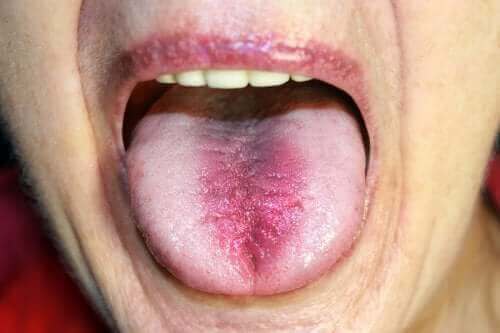 Zespół pieczenia w jamie ustnej: rozpoznanie i leczenie