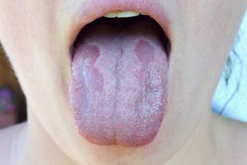 Infekcja bakteryjna języka