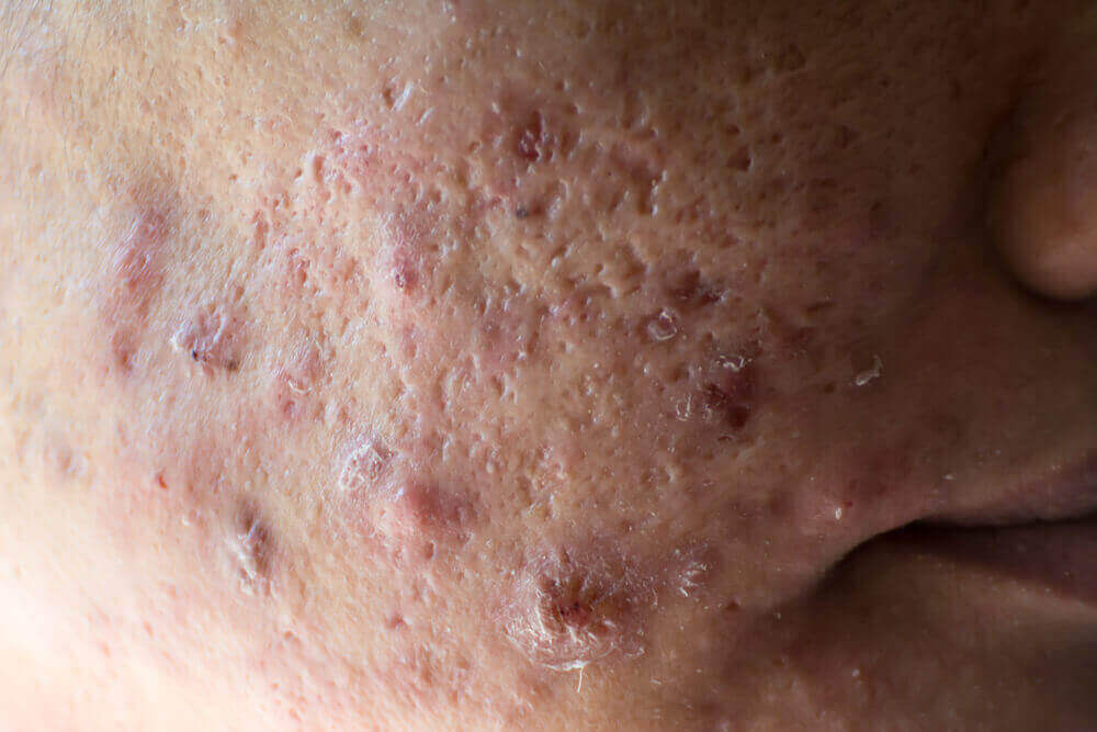Trądzik torbielowaty - najbardziej agresywna odmiana trądziku
