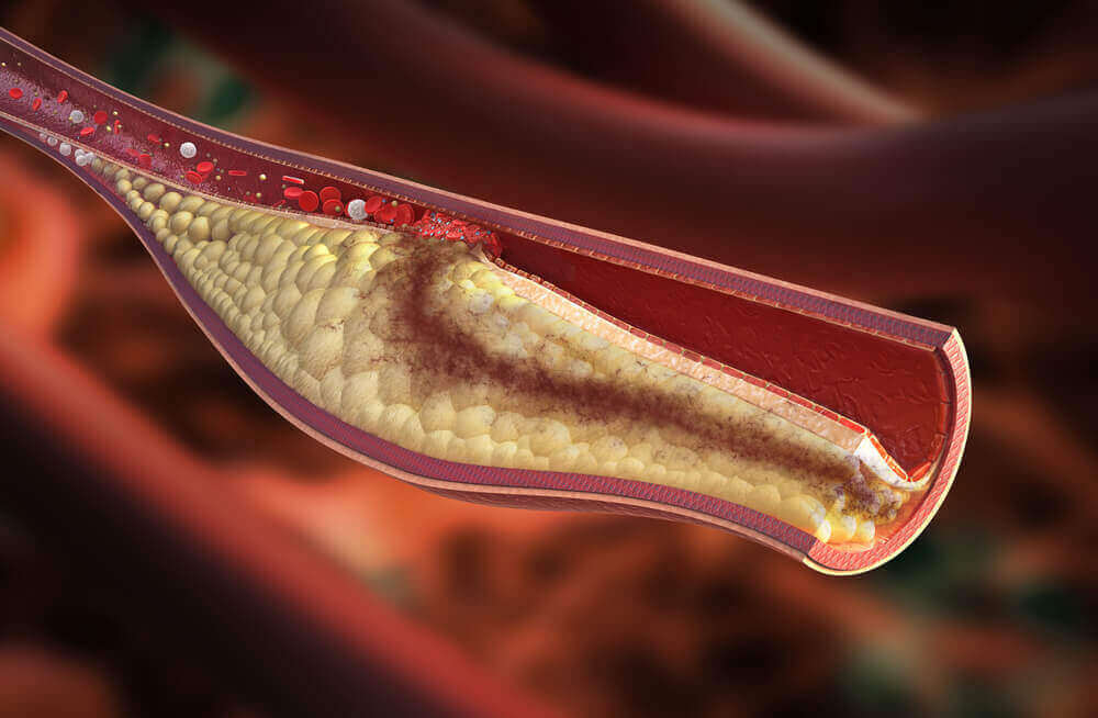 Zły cholesterol, LDL, blokuje tętnice, a dobry, HDL, usuwa jego nadmiar z organizmu.