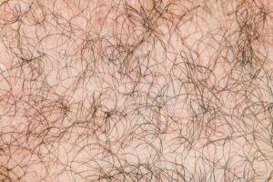 Hipertrichoza, czyli zespół wilkołaka