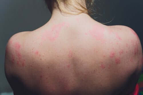 Co to jest promieniowate zapalenie skóry?