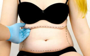 Co to jest abdominoplastyka, czyli plastyka brzucha?