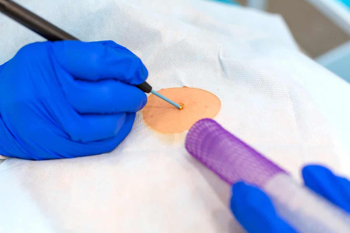 Biopsja jest konieczna w przypadku amyloidozy.