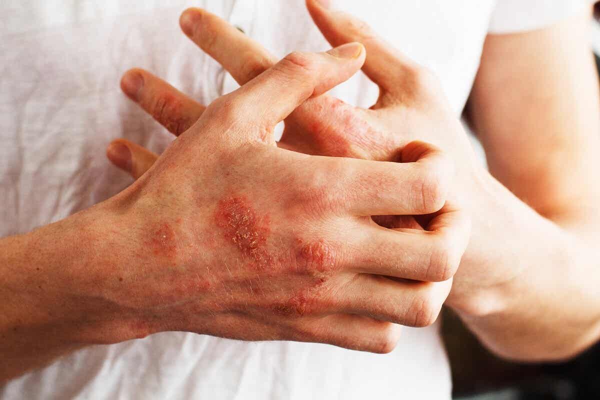 Łuszczyca osłabia skórę i zwiększa podatność na infekcje.