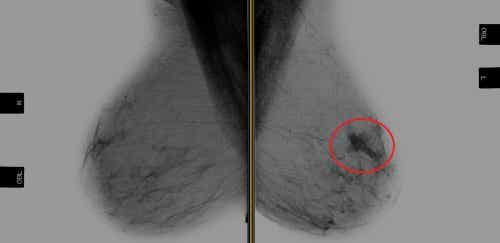 Obraz rentgenowski piersi