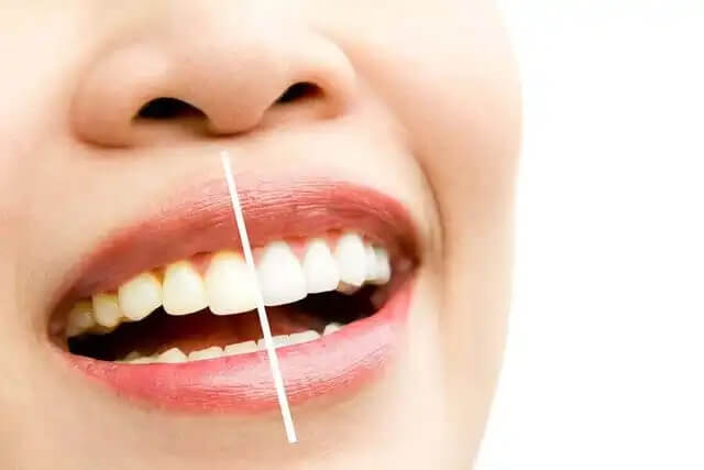 Przyczyny przebarwień zębów