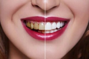 Przyczyny przebarwień zębów - czy znasz najważniejsze z nich?