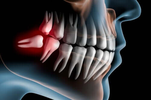 Czym są zatrzymane zęby mądrości i jak się je leczy?