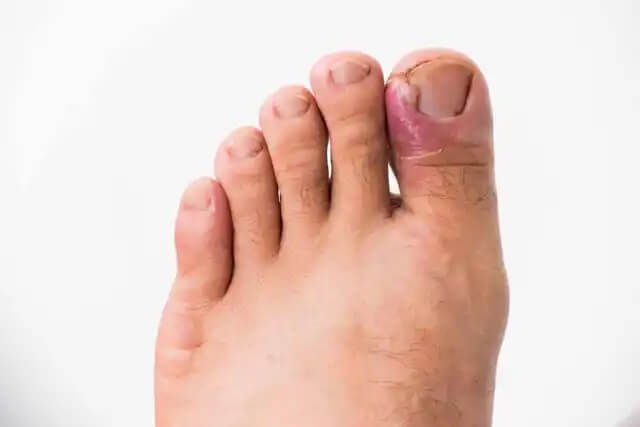 grzybica paznokci