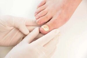 Infekcje grzybicze paznokci – 7 sposobów ich zapobiegania
