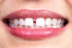Diastema dentystyczna: na czym polega?