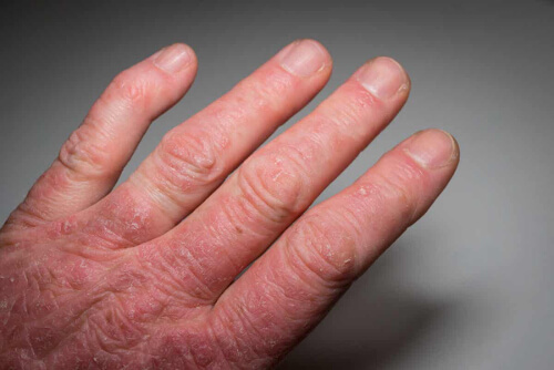 Objaw Raynauda