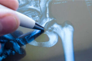 Złamanie kości biodrowej: najważniejsze informacje
