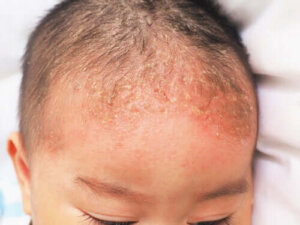 Łojotokowe zapalenie skóry u niemowląt — co warto wiedzieć?