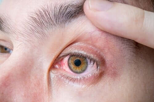 Czerniak gałki ocznej: objawy i przyczyny