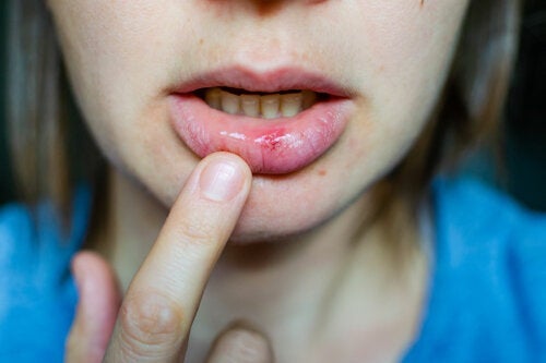 Owrzodzenie jamy ustnej — skuteczne sposoby na rozwiązanie problemu