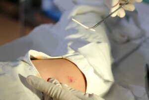 Czy nadal możesz zajść w ciążę jeśli masz implant progestynowy?