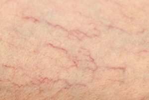 Żylaki i pajączki - jak wyeliminować je w naturalny sposób?