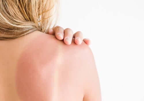 Domowe sposoby na naturalne rozjaśnienie poparzonej słońcem skóry