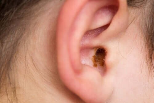 Zaklinowanie woskowiny w uchu - co można zrobić?