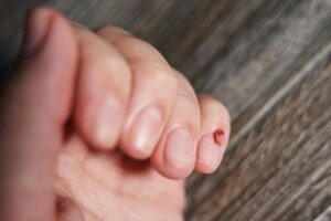 Guzy paznokci - co można zrobić i jak je rozpoznać?