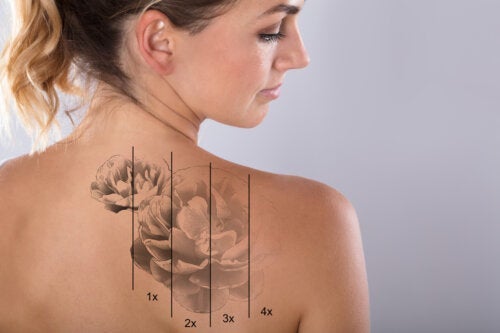 Jakie ryzyko niesie ze sobą laserowe usuwanie tatuażu?