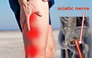 Leki na ból nerwu kulszowego