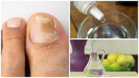 Zrób swój własny naturalny środek do usuwania grzyba paznokci