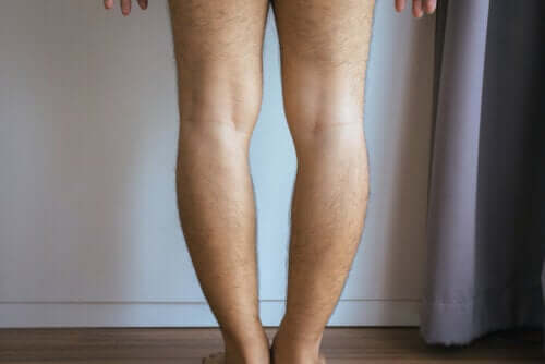 Genu varum, czyli szpotawe kolana - przyczyny i leczenie