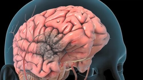 Zakrzepica tętnic mózgowych - przyczyny, objawy i leczenie