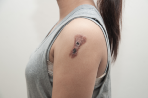 Rak płaskonabłonkowy - przyczyny, objawy i leczenie