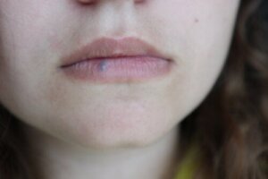 Rak warg: przyczyny, objawy i leczenie