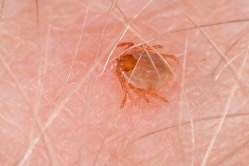 Gorączka plamista Gór Skalistych: objawy i leczenie