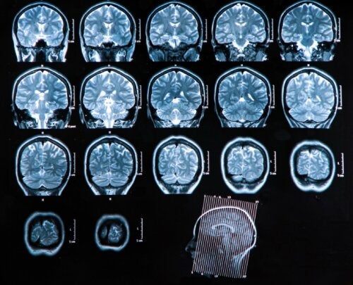 Ropień mózgu: diagnoza i leczenie