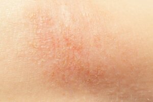 Sucha skóra - naturalne sposoby pielęgnacji
