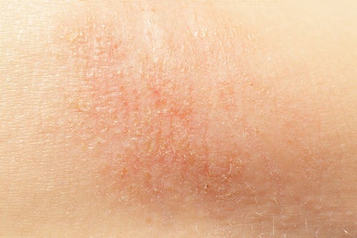 Sucha skóra – naturalne sposoby pielęgnacji