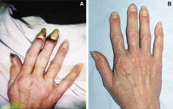 Przyczyny, objawy i leczenie choroby Buergera