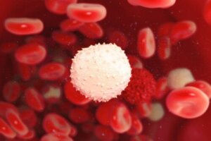 Makroglobulinemia Waldenströma - na czym polega?