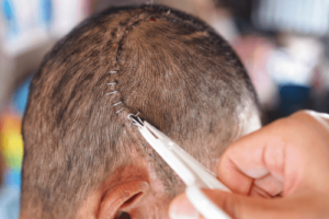 Co to jest kraniotomia i kiedy jest konieczna?