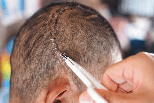 Co to jest kraniotomia i kiedy jest konieczna?